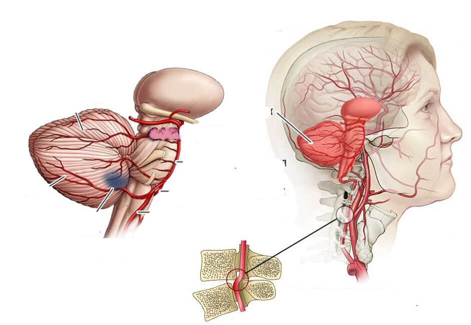Cerebelarna ishemija
